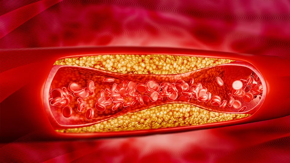 Diagnostizierst du es? Kind mit Xanthomen und Brustschmerz