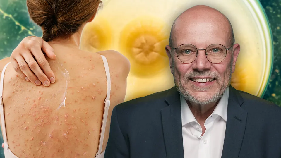 Kleienpilzflechte (Pityriasis versicolor) – Von der Diagnose zur Therapie