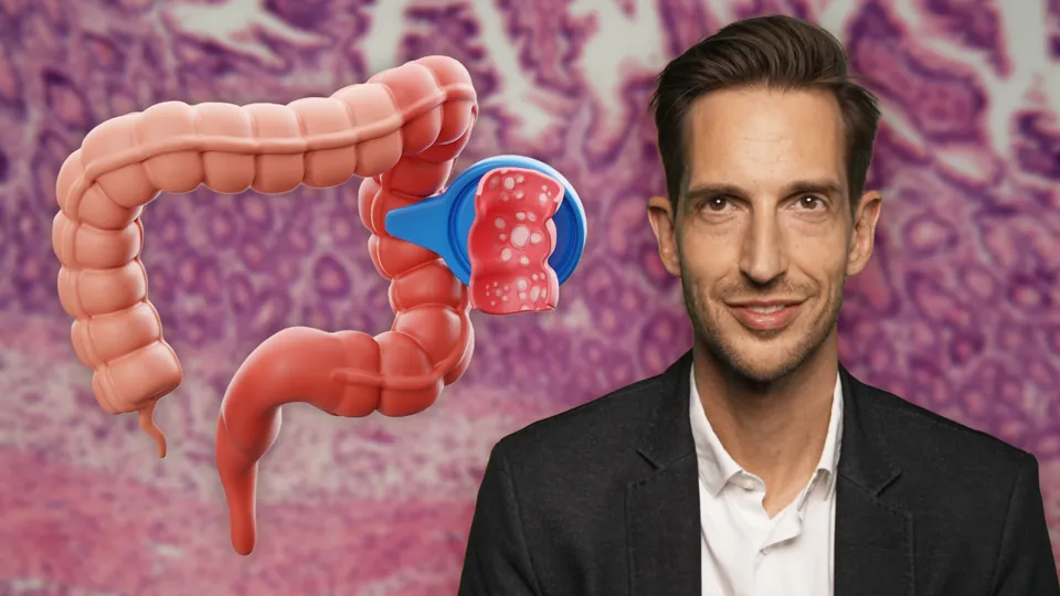 Update zur Colitis ulcerosa