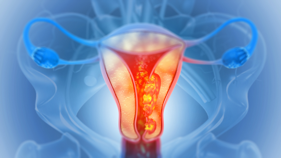 Endometriumkarzinom: Chemotherapiefreie Behandlung beim Endometriumkarzinom