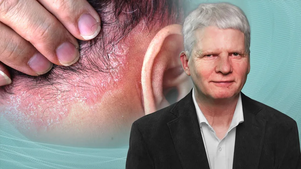 Seborrhoisches Ekzem der Kopfhaut – Diagnostik und modernes Management