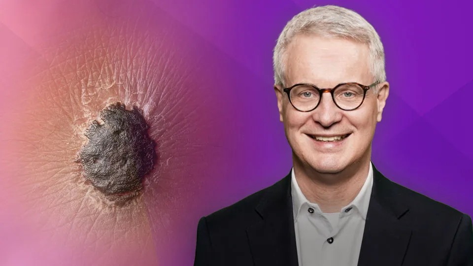 Immuntherapie Malignes Melanom 2025