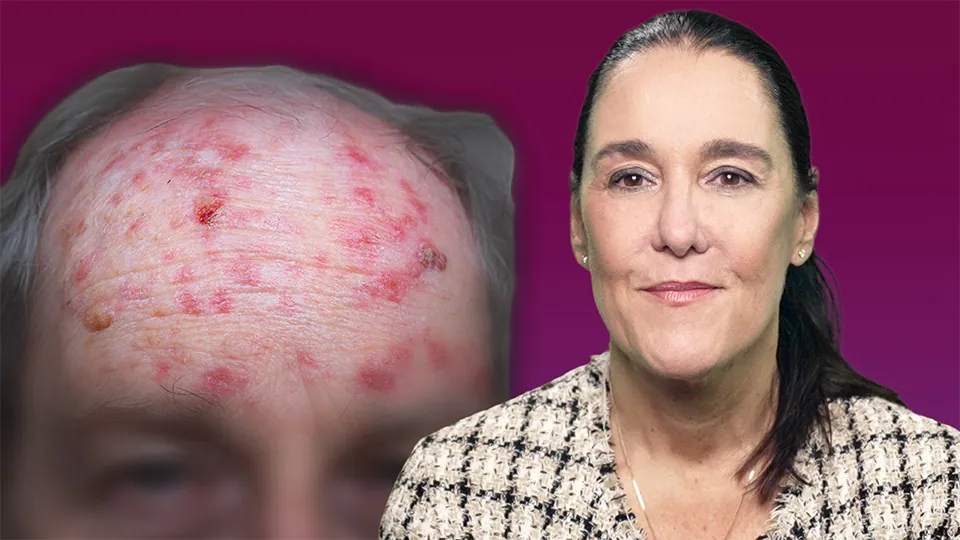 Aktinische Keratosen für Hausärzte – Teil 2