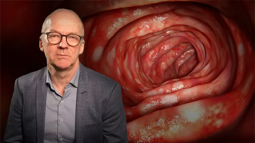 Colitis Ulcerosa