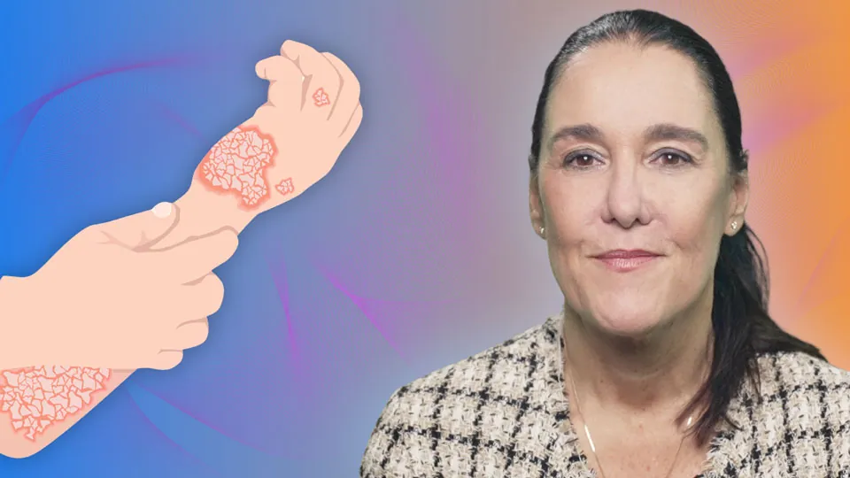 Psoriasis vulgaris für Hausärzte