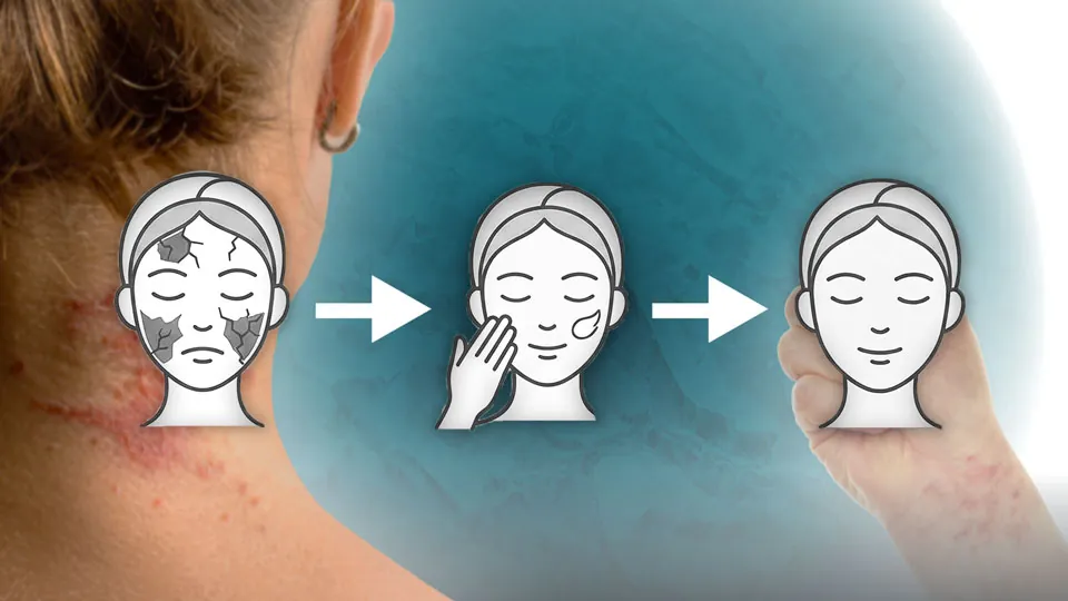 Psoriasis für Hausärzte