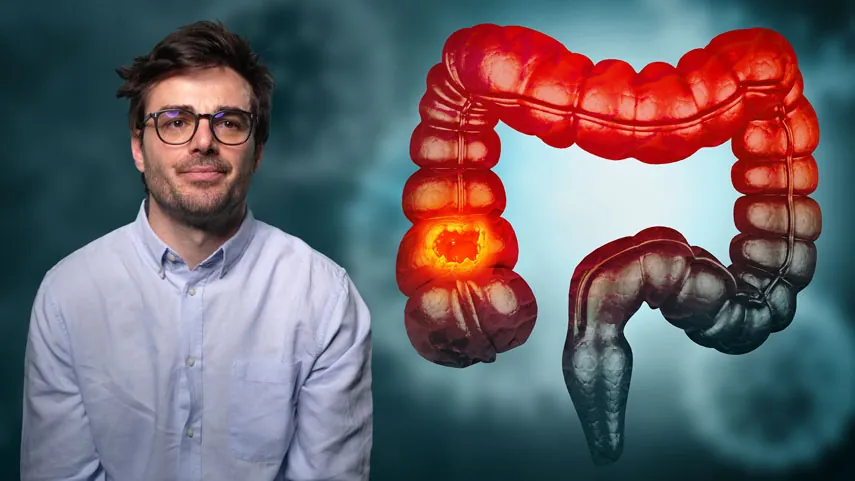 Nebenwirkungen durch Chemotherapie (5FU) bei metastasiertem kolorektalen Karzinom: Hand-Fuß Syndrom - Bedeutung, Auswirkungen und Therapie